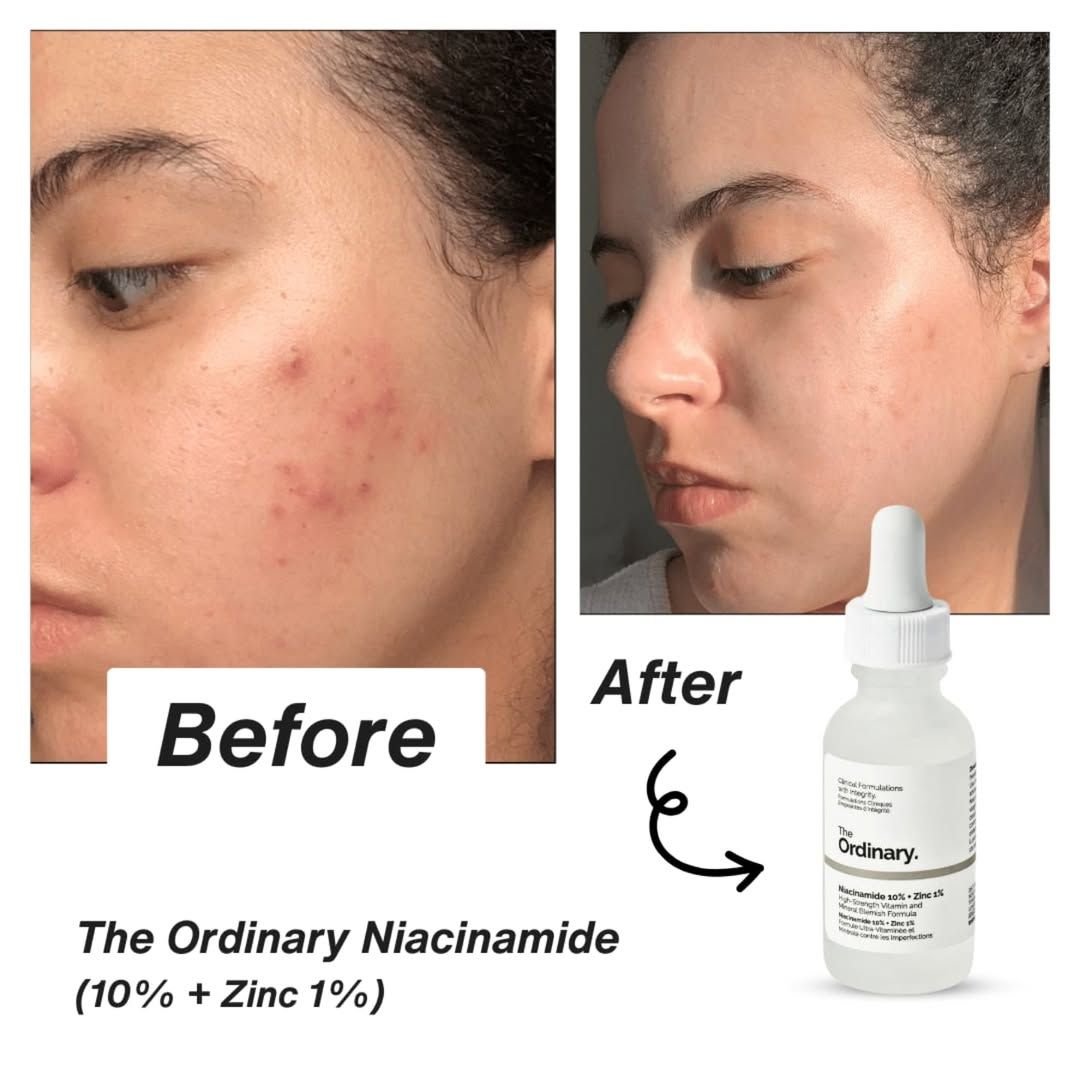 the ordinary niacinamide 10% + zinc 1% – advanced skin clarifying serum the ordinary niacinamide 10% + zinc 1% – advanced skin clarifying serum
